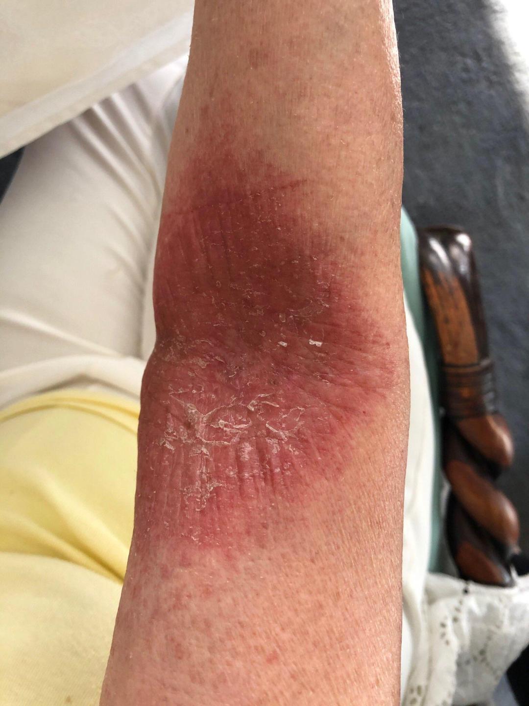 Exosomes 23 Stasis Dermatitis Recharge Biomedical