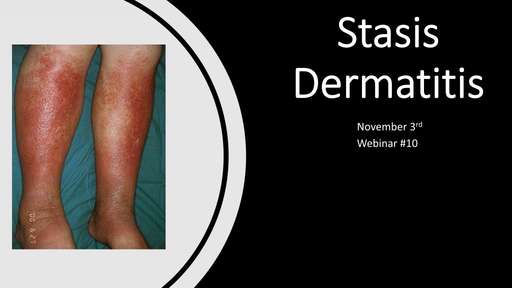 stasis dermatitis